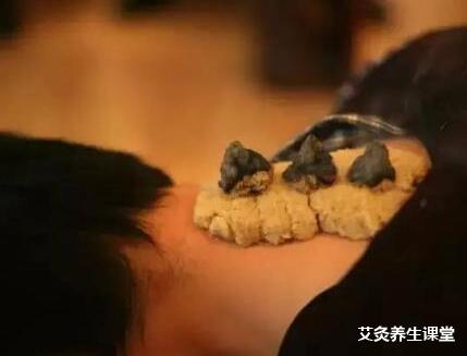 艾灸可以戒烟?看看你就知道了