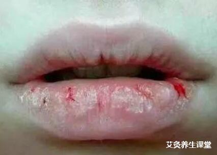 唇干、裂、糜烂要艾灸哪个部位?