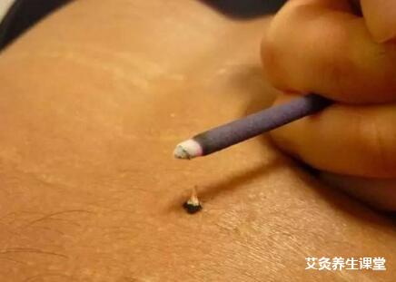 艾灸疗法养生保健可预防疾病胜过吃药打针