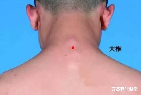 小孩子可以艾灸大椎吗?