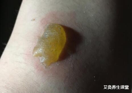 艾灸烫伤怎么处理?艾灸避免烫伤要注意什么?